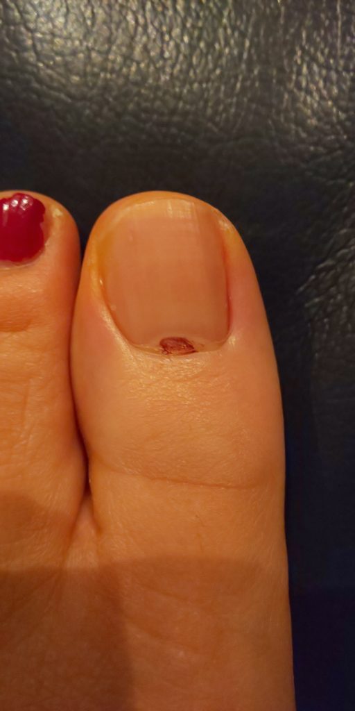 私の足の爪にガン と大騒ぎした件 矢沢医師ブログ