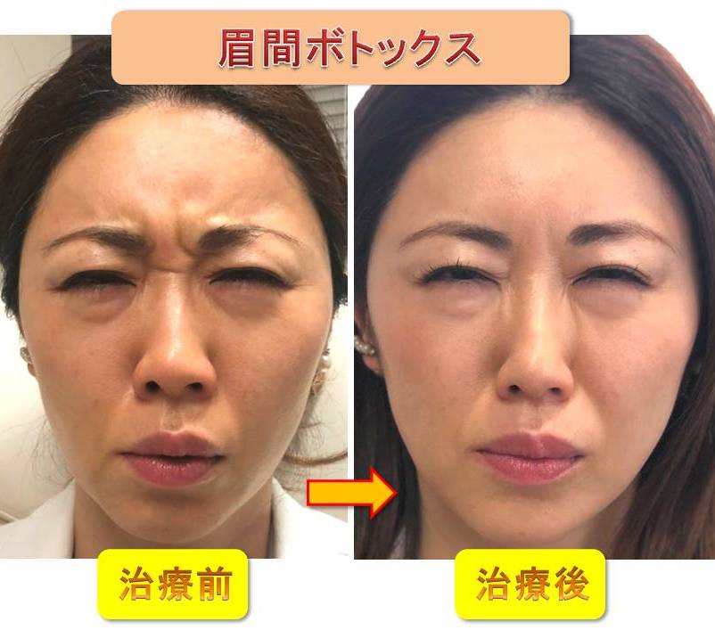 眉間ボトックスと目尻ボトックスの合わせ技で上瞼が二重に被るのを改善できる ビフォーアフター有 矢沢医師ブログ